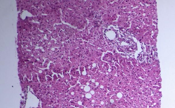 ggt谷氨酰转肽酶偏高有什么危害,ggt谷氨酰转肽酶偏高多少严重