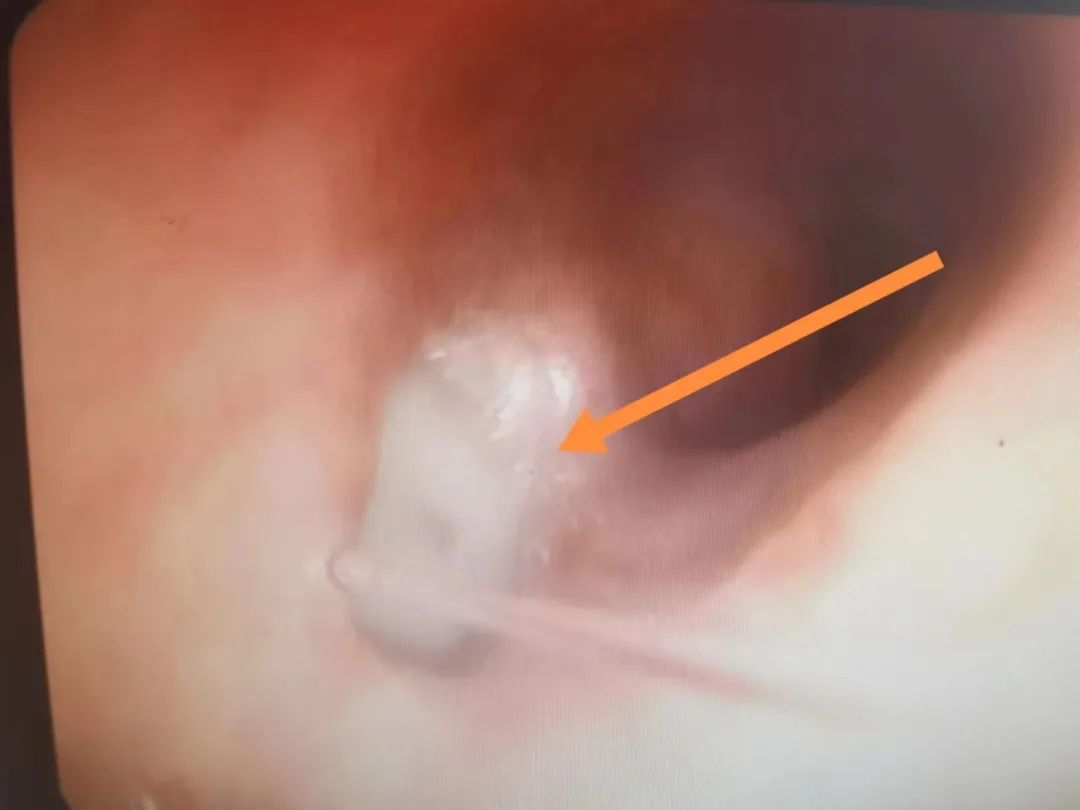 气管食道小瘘口能痊愈吗,食道管瘘还可以治疗吗