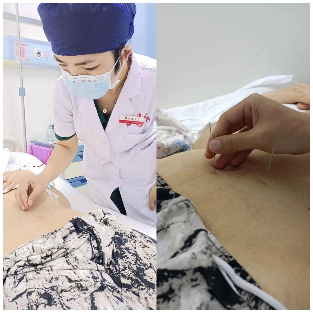 中医治疗多囊卵巢综合症效果好吗,舒氏针灸一般能治好多囊卵巢吗