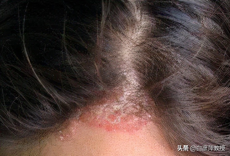 银屑病头皮怎么涂药,银屑病的涂药方法