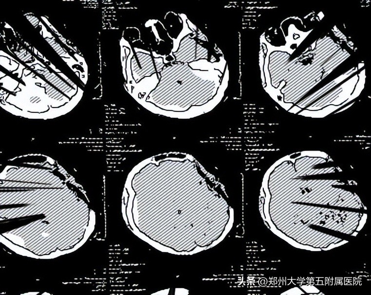 脑出血意识障碍康复,意识障碍的康复治疗