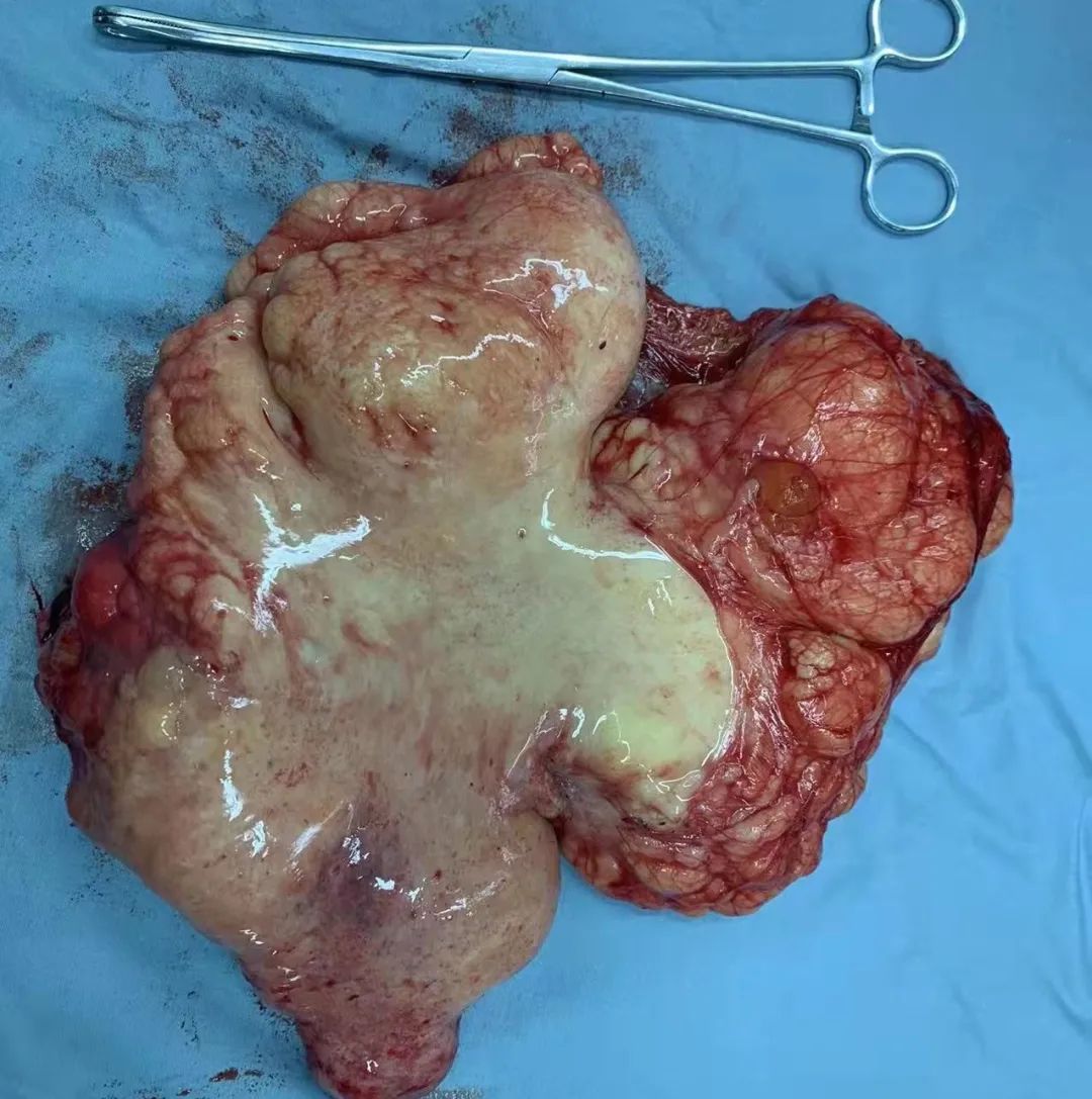 花季少女切除脏器,花季少女肚子肿瘤