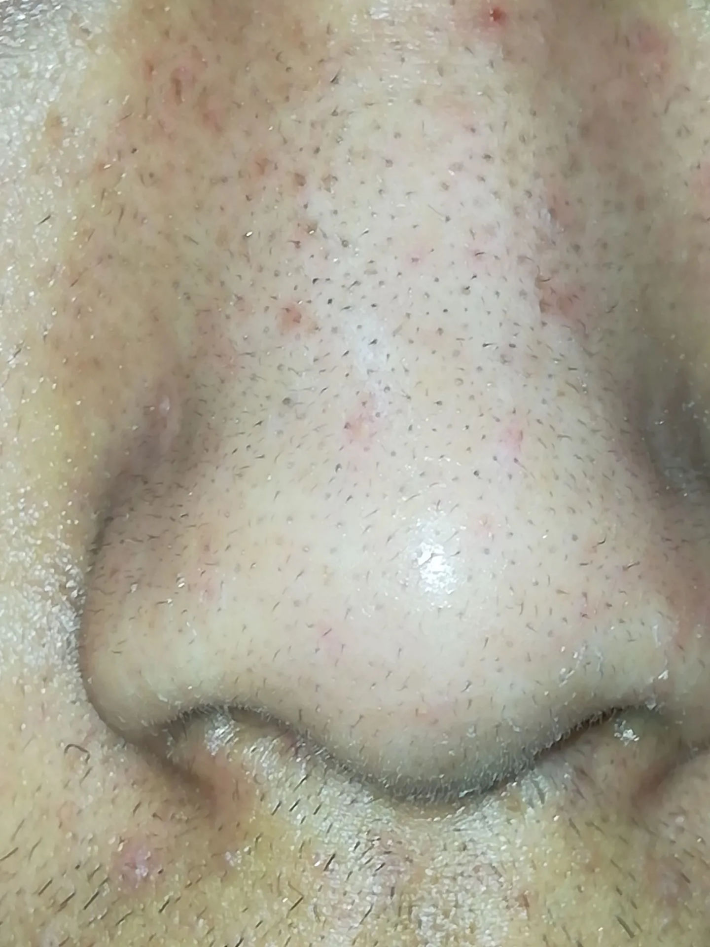 真黑头假黑头傻傻分不清楚，怎么去黑头？