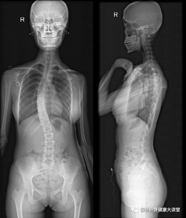 生长发育引起的脊柱侧弯,医学讲解脊柱侧弯怎样引起