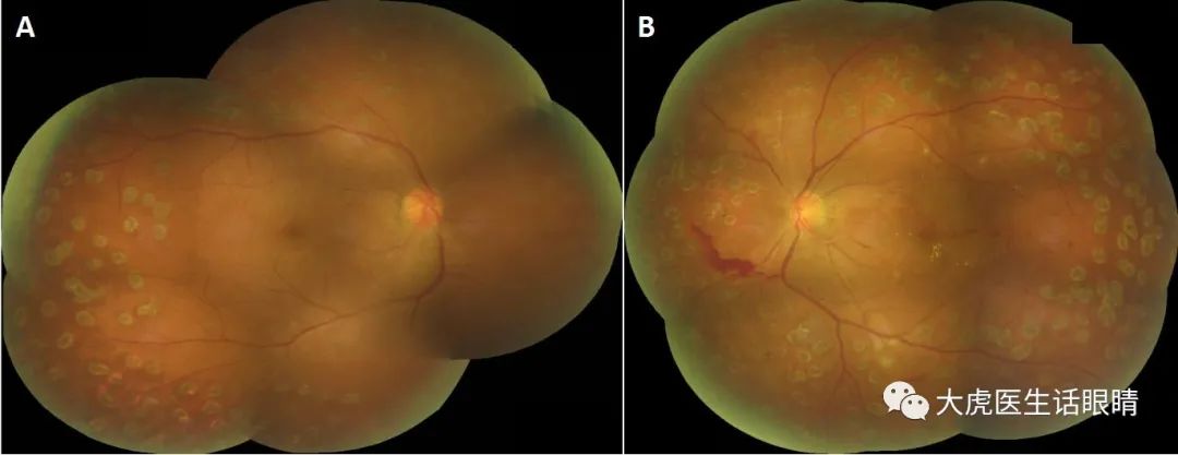 放射性视神经病变,放射性脑炎影像表现