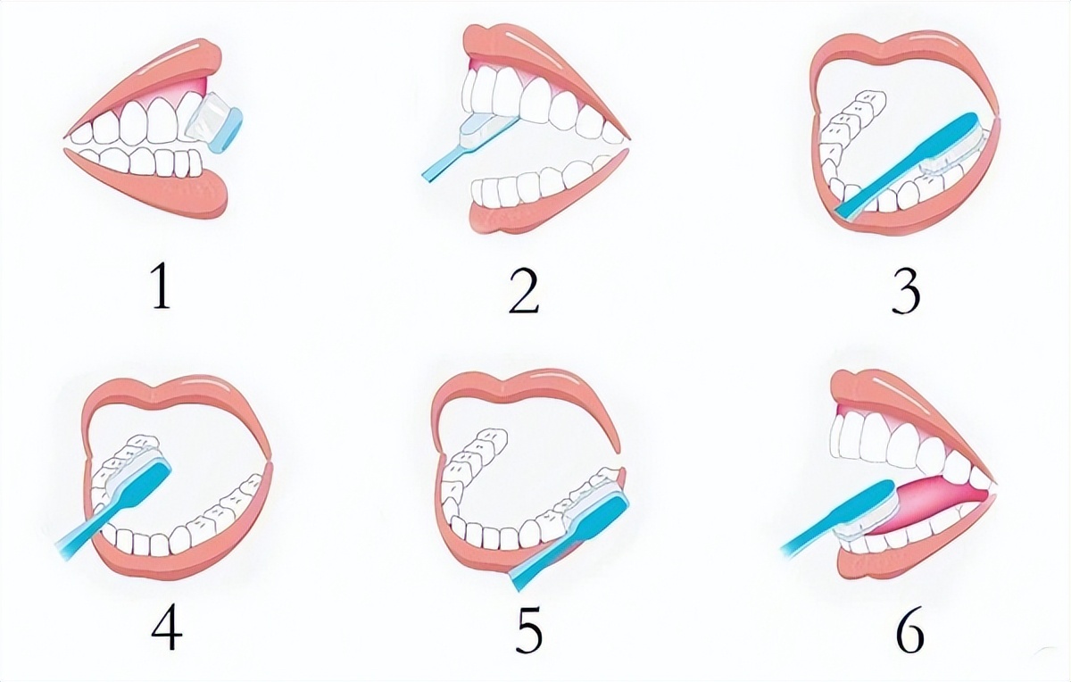 蛀牙有什么注意事项,蛀牙龋坏怎么预防