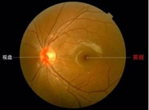 眼睛长黄斑怎么去除,黄斑是黑眼球还是白眼球