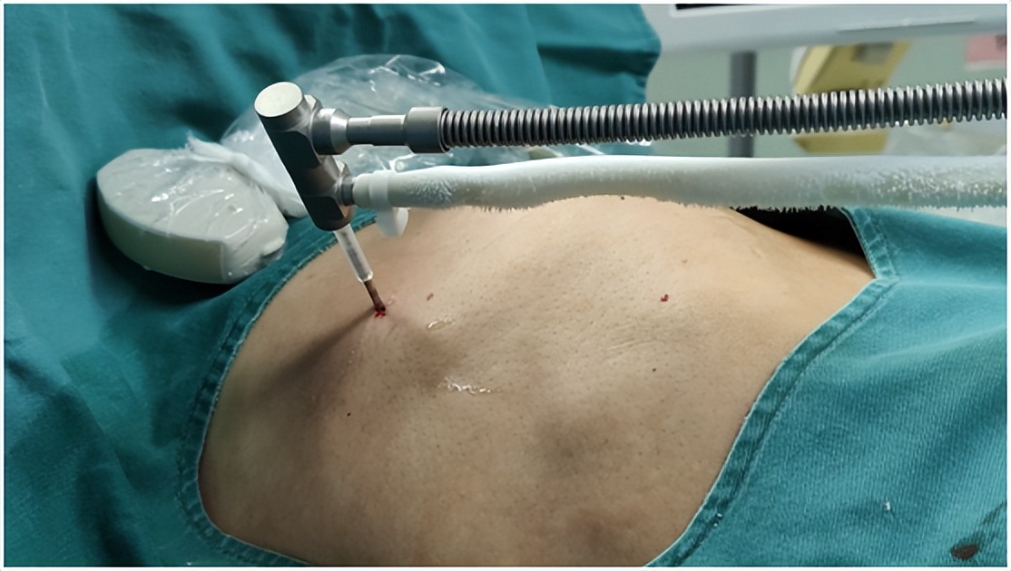 康博刀治疗肺癌一次要多少钱,康博刀能治肺部肿瘤