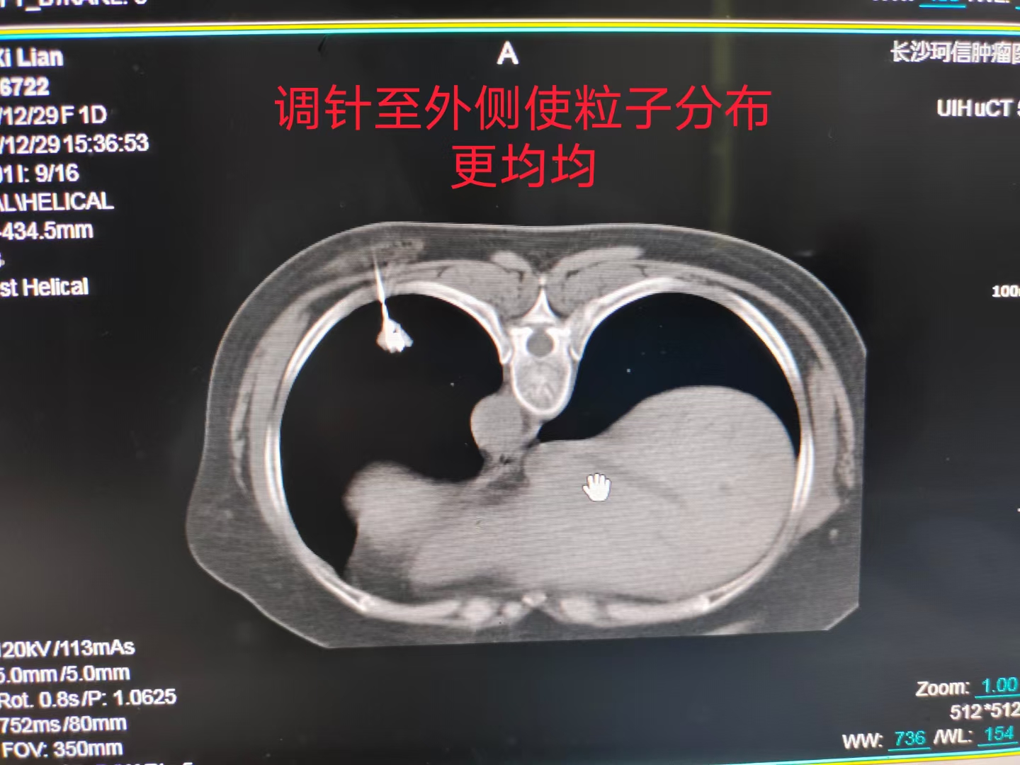 11厘米肺癌肿瘤粒子植入,肺癌多处转移放射治疗全过程