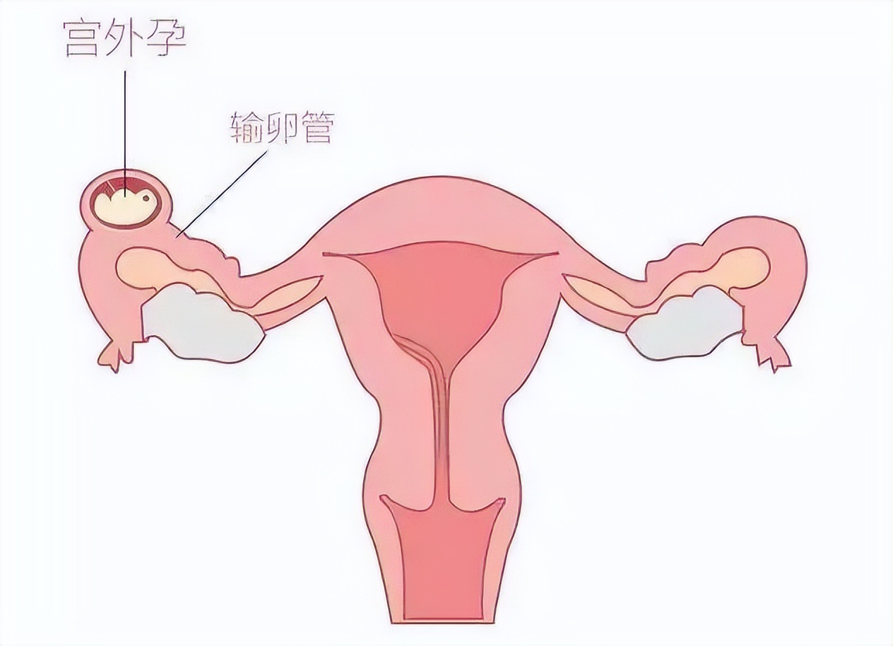 月经没来小腹左侧轻微痛怎么回事,月经没来小腹部隐痛可要当心了