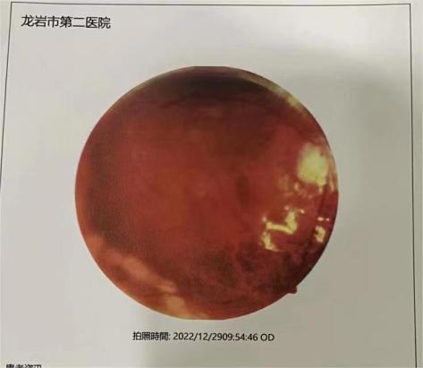 视网膜脱落找不到怎么办,视网膜脱落不能手术怎么办