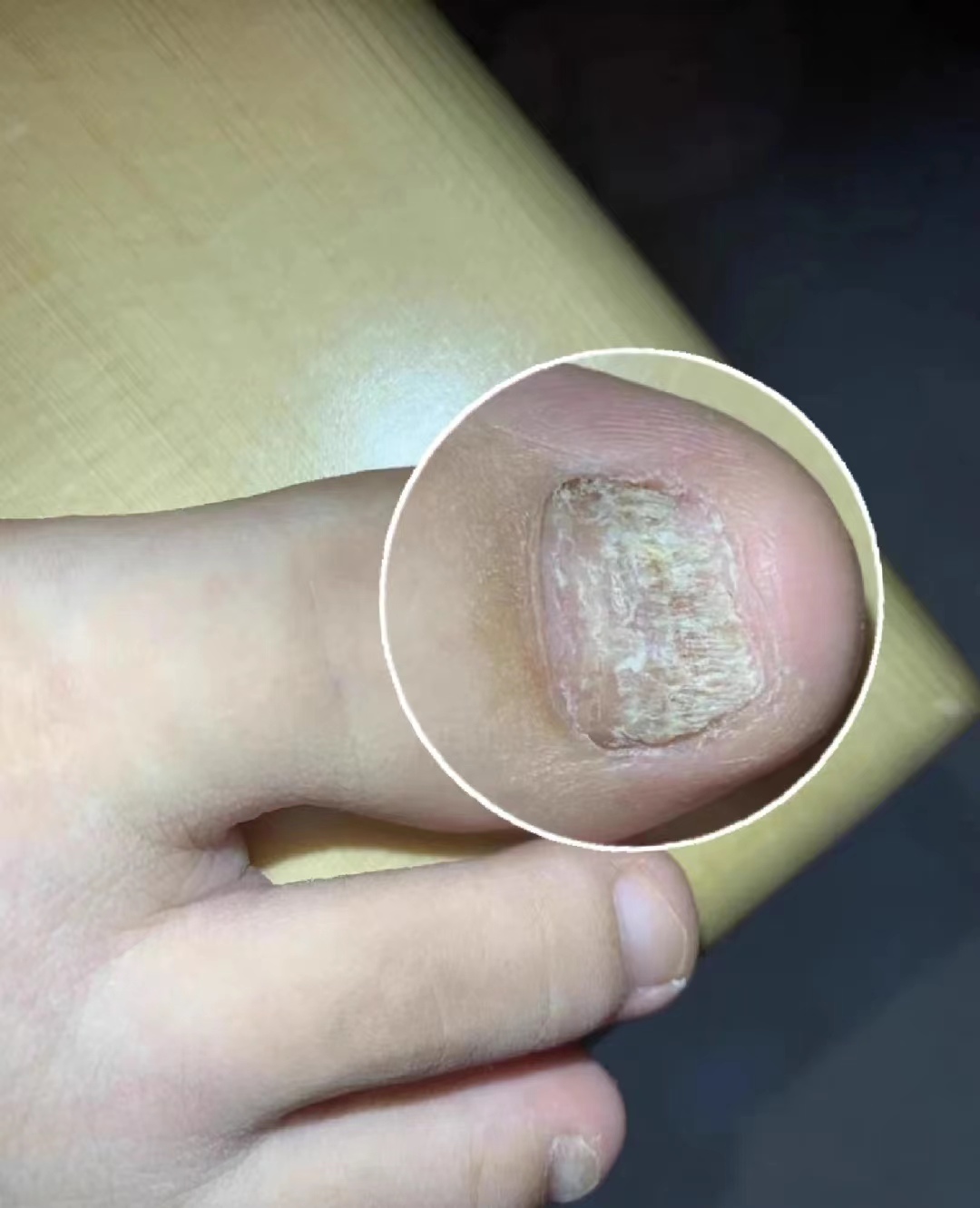 治疗灰指甲亮甲正确使用方法,去灰指甲的小方法