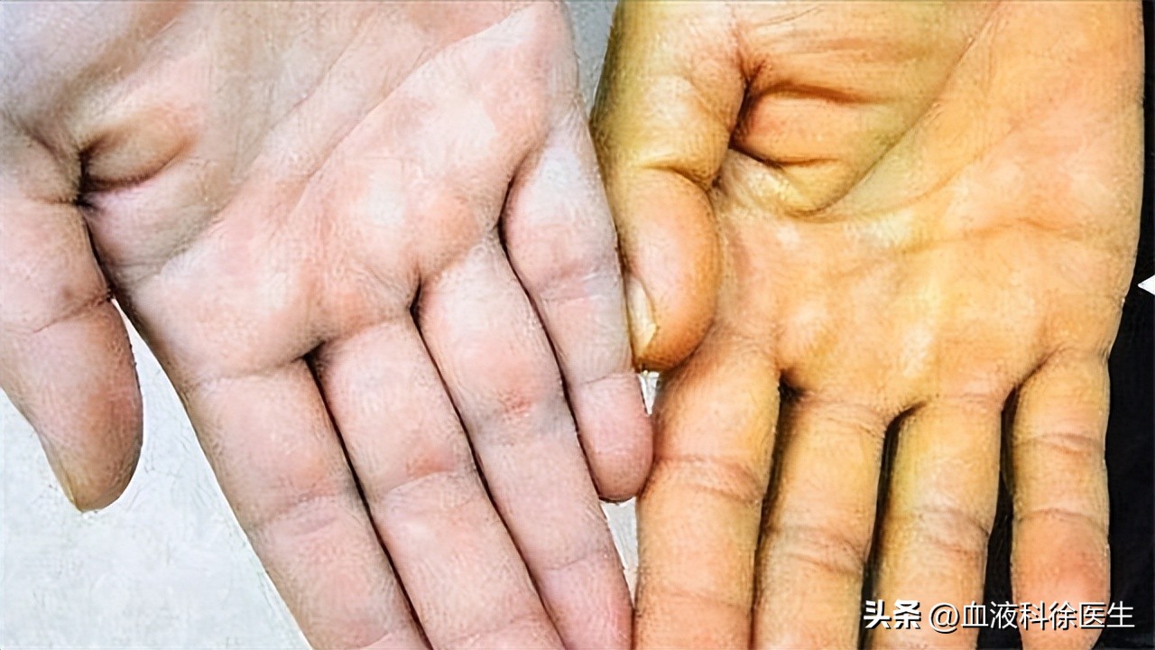 胆管癌的早期4大症状是什么呢,发现胆管癌要注意这4点