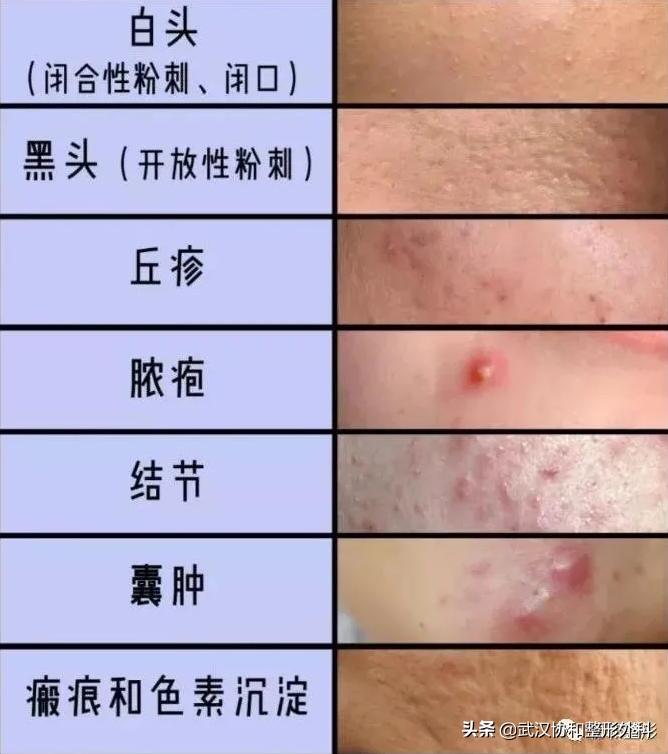 痘痘反反复复怎么办,脸上的痘痘反反复复