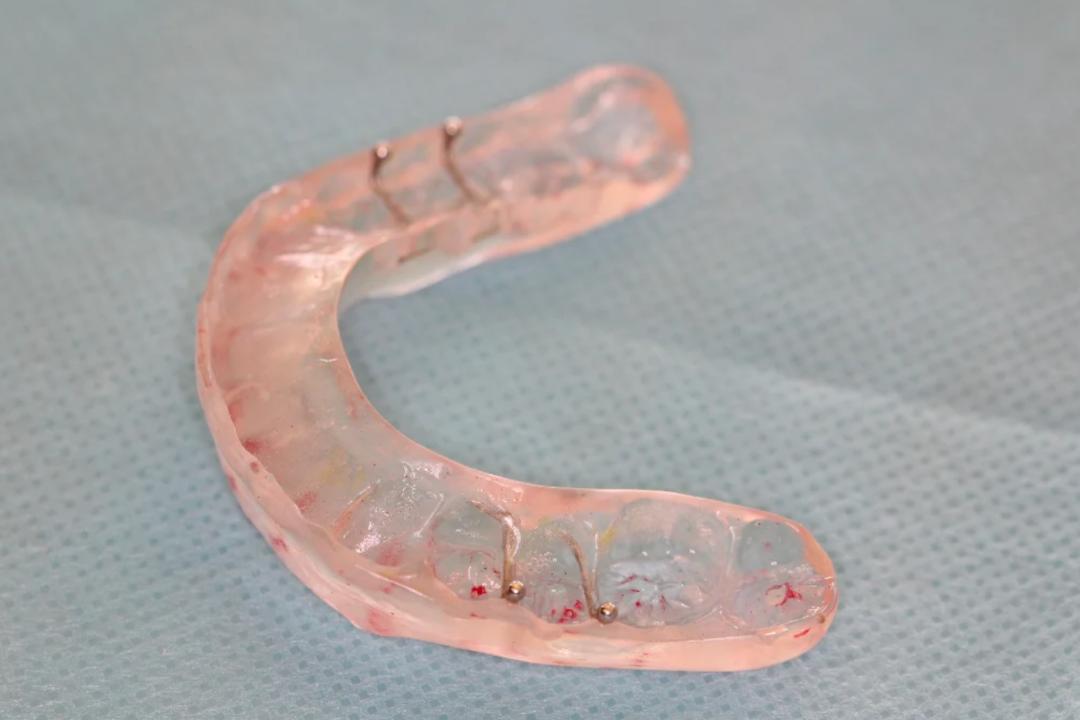 睡觉磨牙怎么治疗最有效,睡觉磨牙怎么治最快