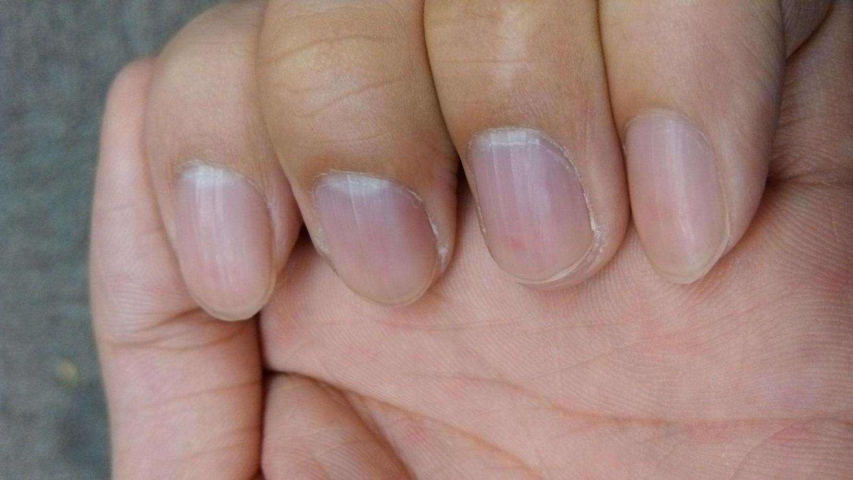 指甲出现异常是肝上出问题了吗,口苦口臭指甲竖纹是肝的问题吗