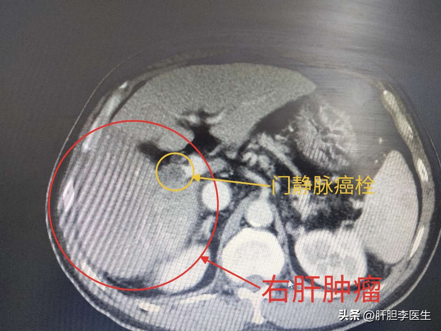 喝酒后晕倒一会儿没事了,喝酒喝急了突然晕倒