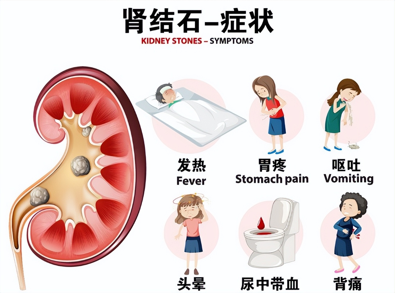 有一种疼叫你不懂结石的疼,肾结石痛得大喊