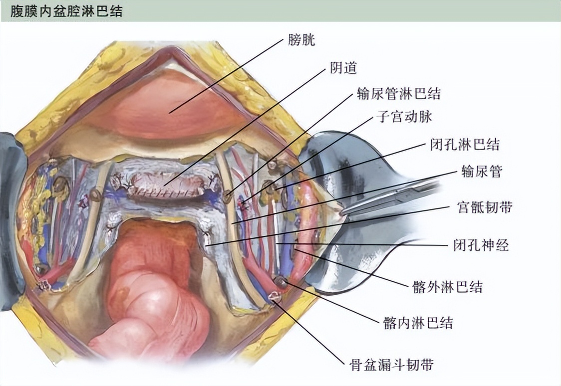 子宫全切？淋巴转移？宫颈癌手术方式有哪些？一文解析