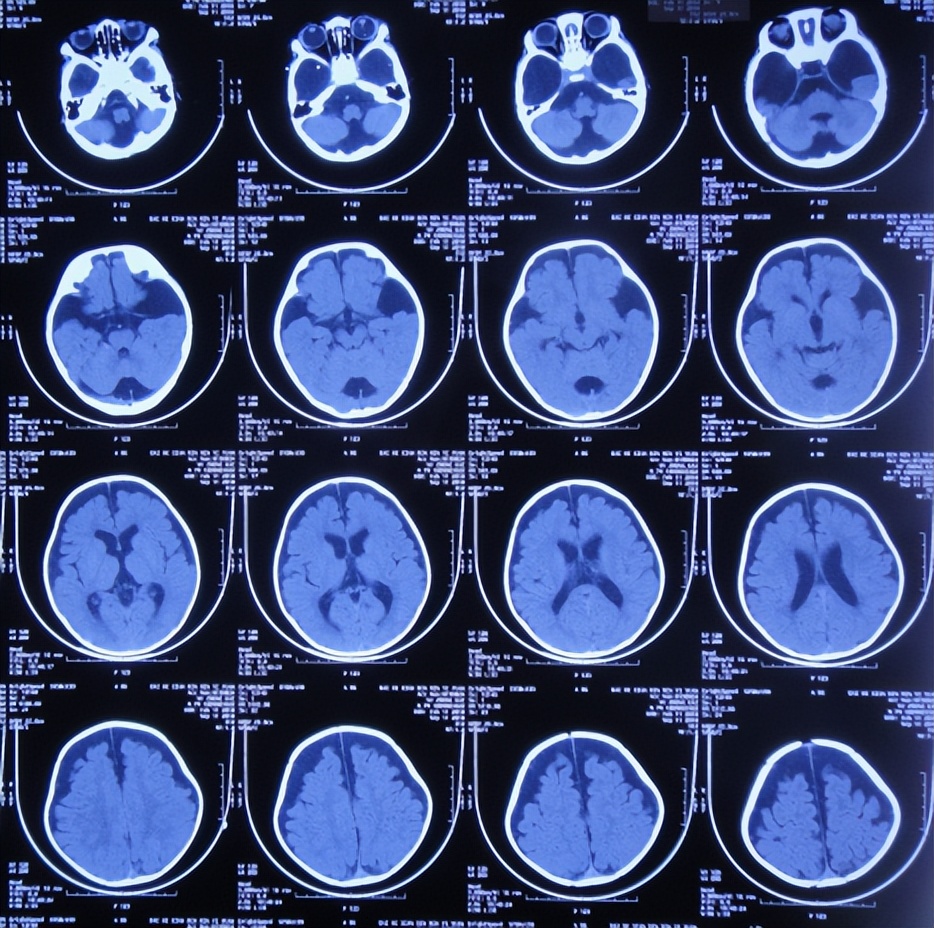 蛛网膜囊肿合并脑积水腹腔分流术,治疗蛛网膜囊肿引起脑积水严重吗