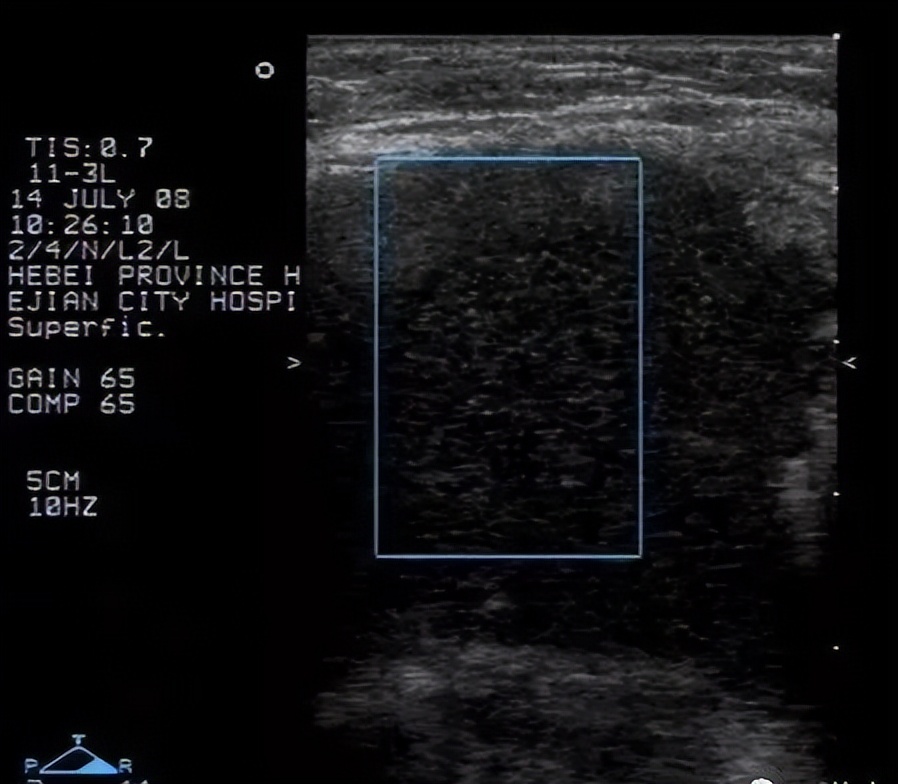 腋窝包块超声鉴别诊断,腋窝淋巴结检查法