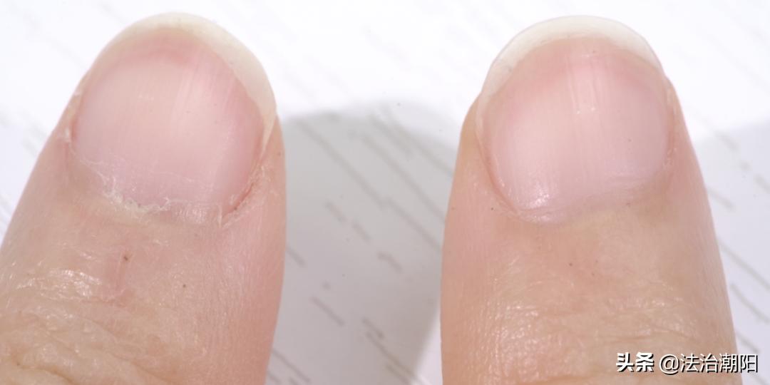 手指长倒刺缺乏哪种维生素,宝宝手指倒刺是缺什么维生素