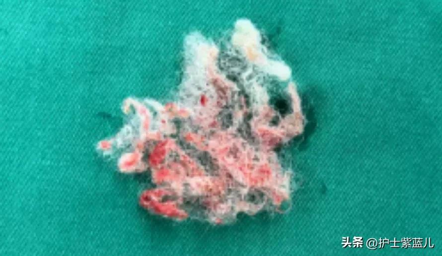 6岁女孩出血怎么回事不疼,6岁女孩出血怎么回事