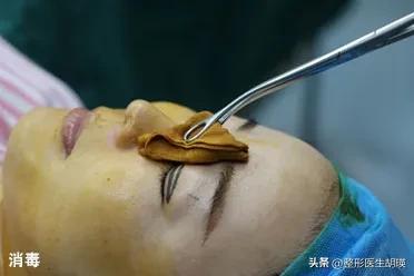 做双眼皮20天大小眼,做双眼皮二十几岁做最好