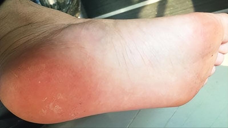 脚底板爱发烫是什么原因,脚底板生茧很疼怎么回事