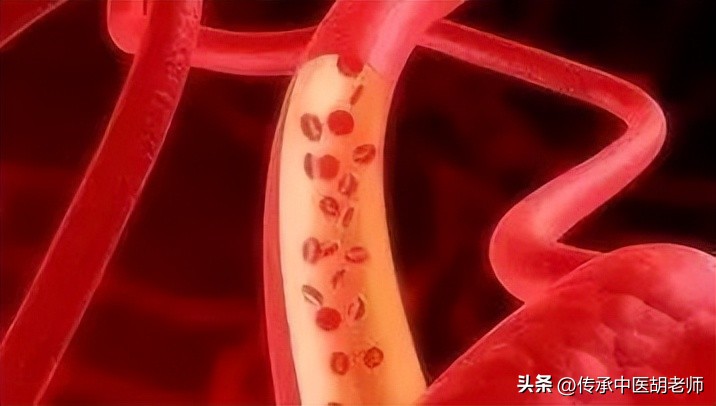 血管被堵，身体遭殃，三个中成药，帮你扫除血管里的痰