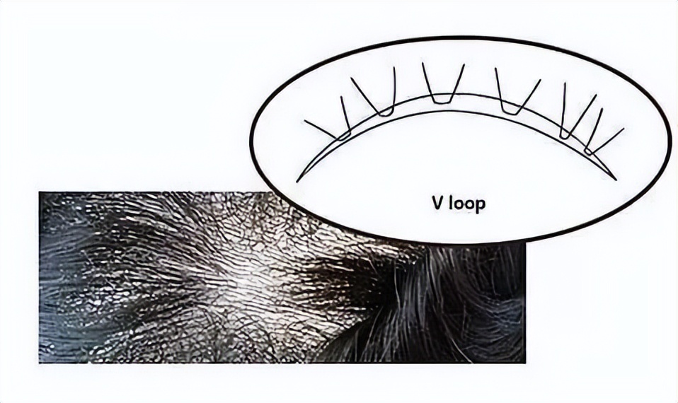 发际线后移遗传吗,发际线后移怎么办适合什么发型