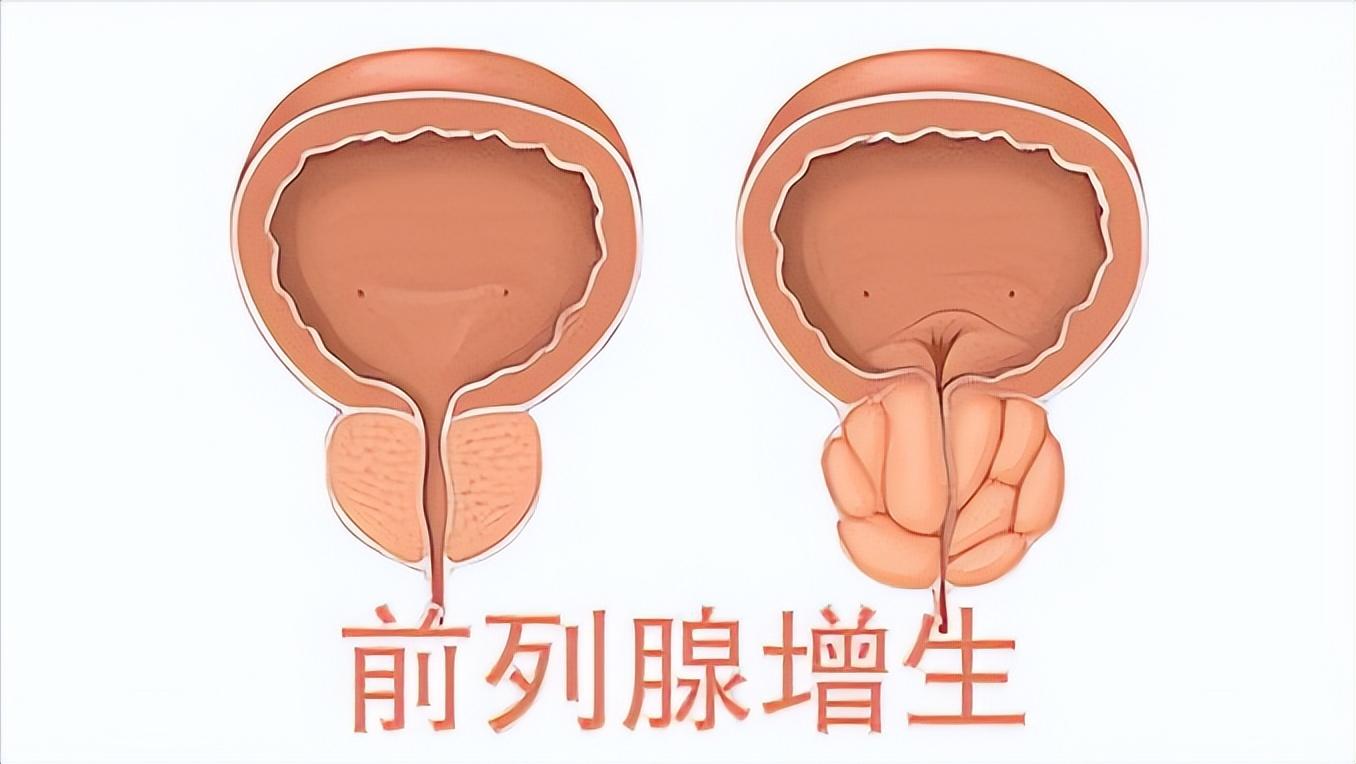 网上说前列腺治愈的都是骗人的吗,网上广告治疗前列腺可信吗