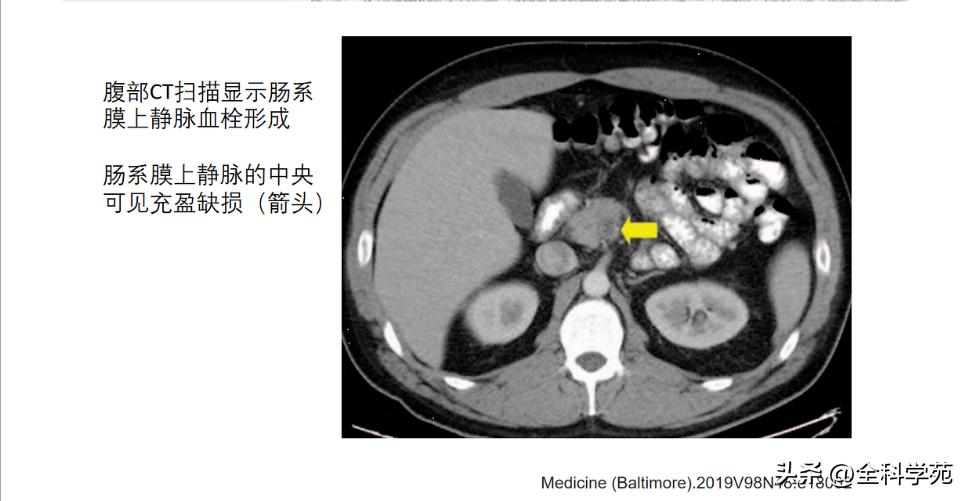 阑尾炎的讲解,关于阑尾炎的讨论总结