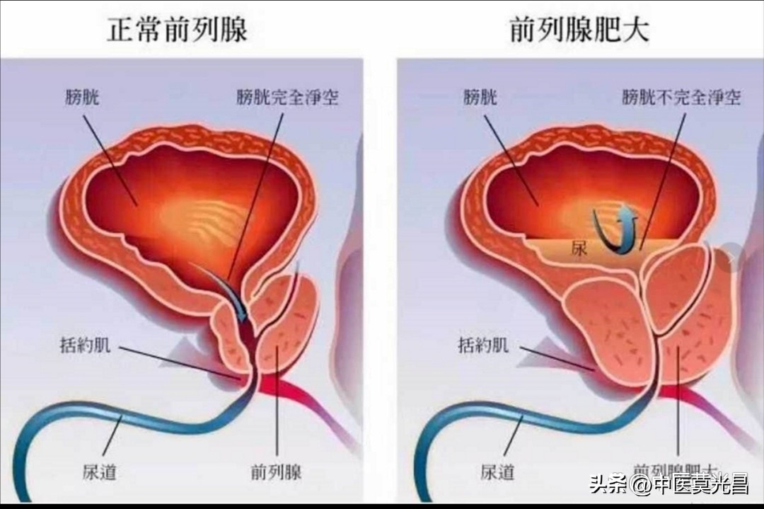 猪苓治前列腺增生吗,猪苓汤治疗前列腺钙化几天能见效