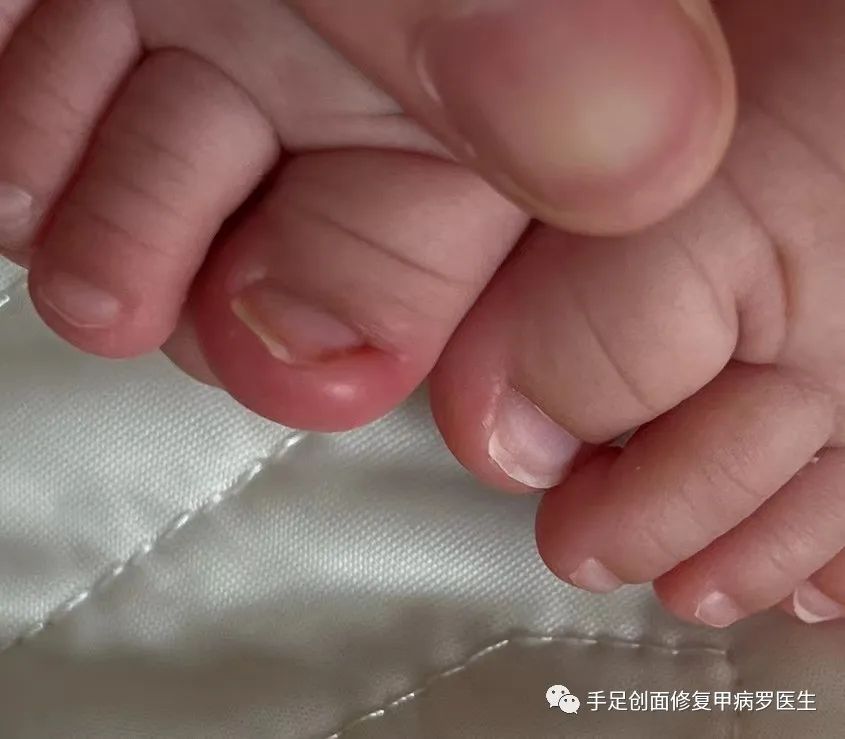 宝宝脚趾甲有脓了怎么处理,给宝宝剪指甲流脓怎么办