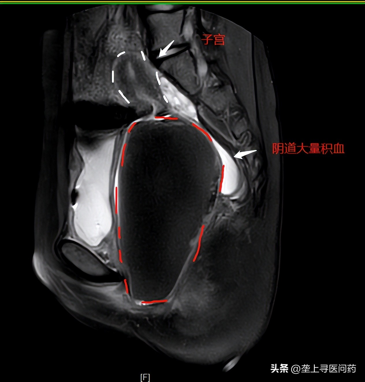 12岁女孩小腹痛是什么原因引起的,12岁女孩腹痛一天什么原因