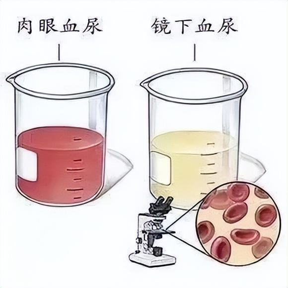 关于血尿的几个疑问,血尿多的吓人