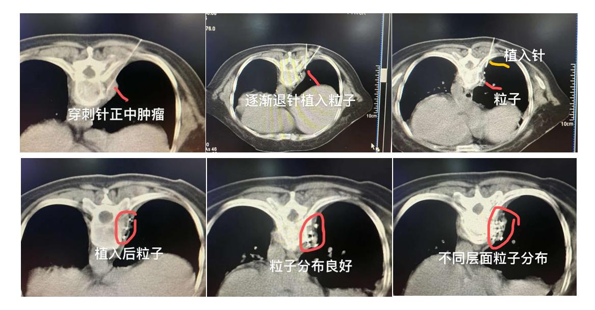 粒子植入治疗淋巴结转移,小细胞肺癌纵隔淋巴结转移后手术