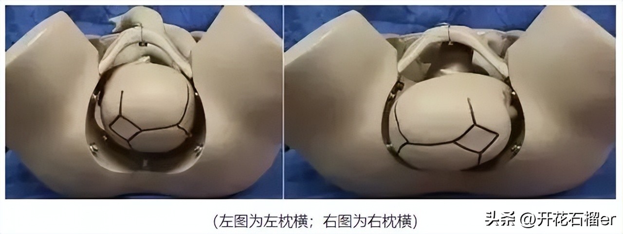 仰头和低头出生的区别,婴儿仰头出生和侧身出生