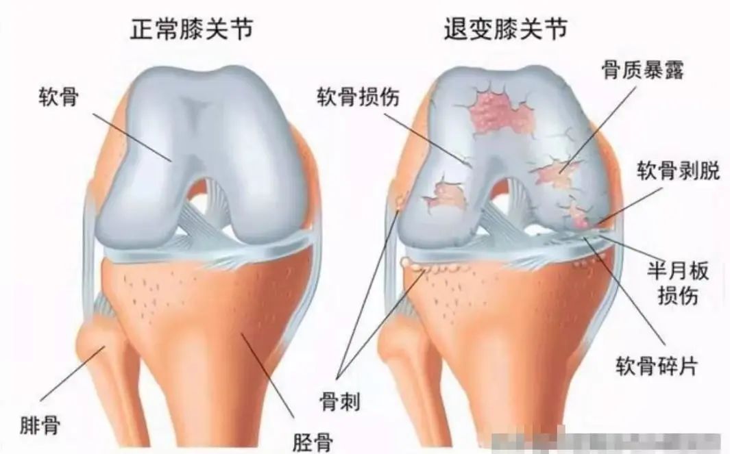 氨糖软骨素对软组织损伤有用吗,软骨损伤氨糖软骨素真的有用吗
