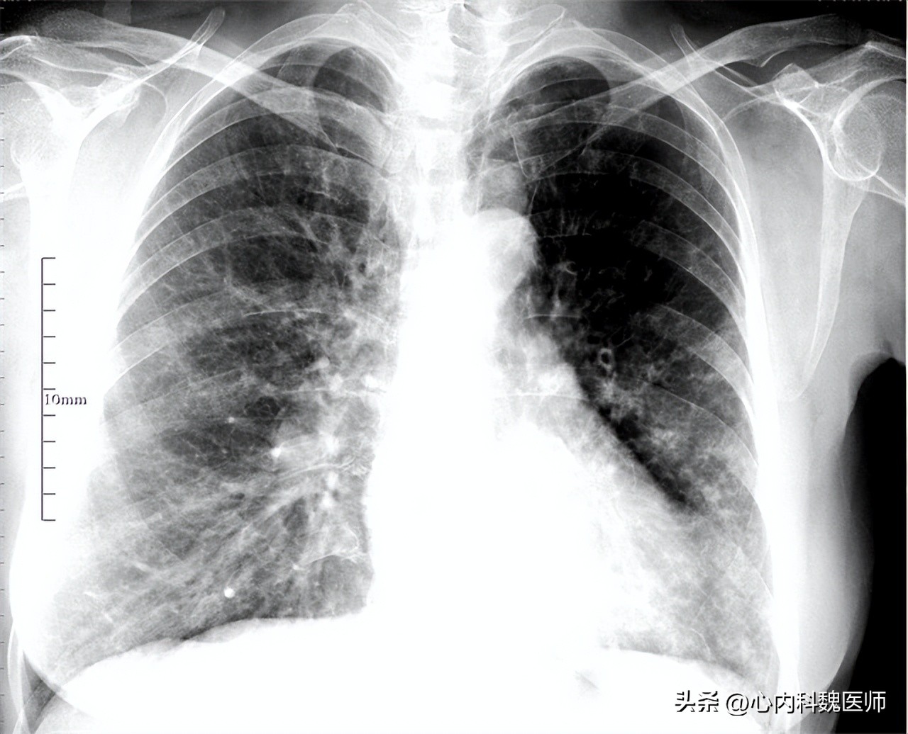 盐酸氨溴索口服溶液治疗肺炎,盐酸氨溴索片对支原体肺炎有效吗