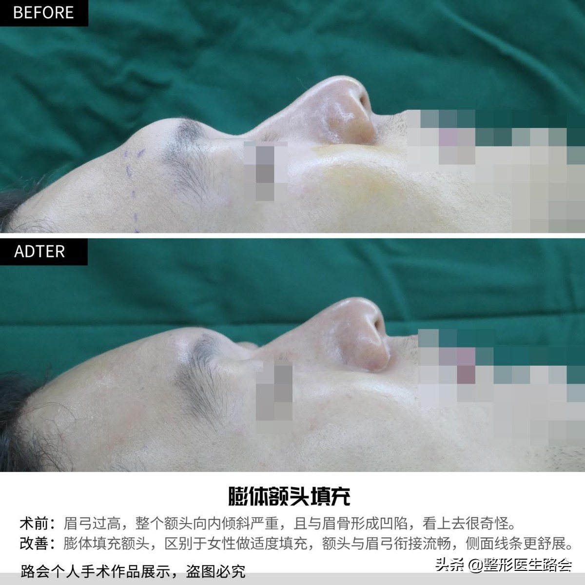 自体脂肪丰太阳穴会不舒服吗,自体脂肪丰额头好还是玻尿酸好