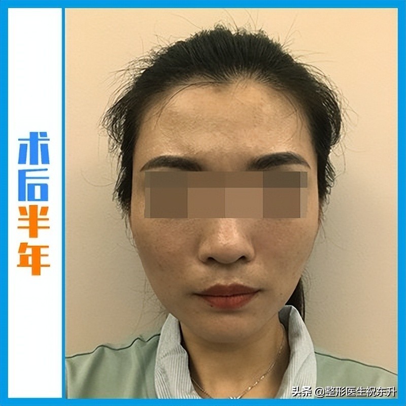 面诊后拉皮除皱,小切口拉皮手术后第一天记录一下