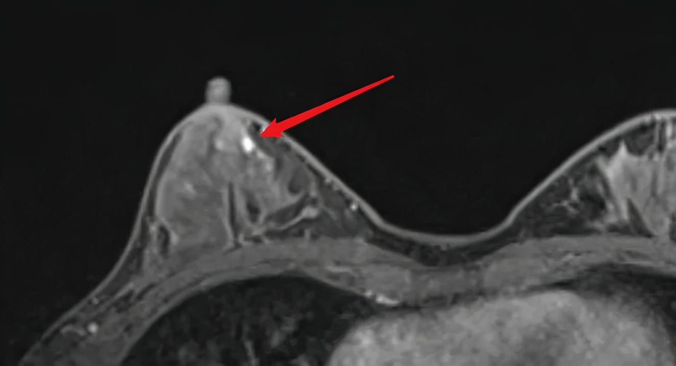 联合检查达到的效果,合并导管原位癌