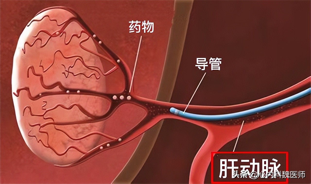 钇90微球疗法肝癌效果,钇90树脂微球治疗肝癌手术费用