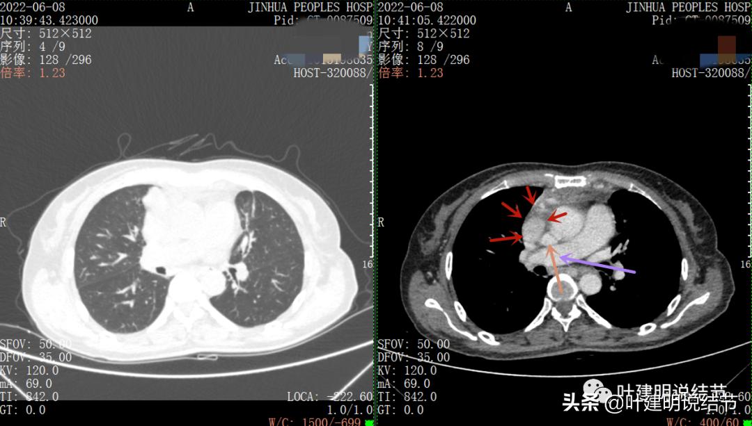 这位老乡，乏力来查，查出这么大个的纵隔肿瘤！会是什么呢？