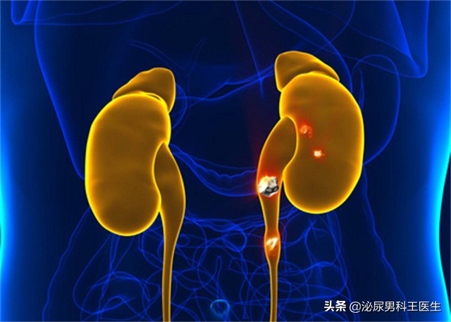 尿酸高如何让尿酸排出体外,尿酸高如何让尿酸排出