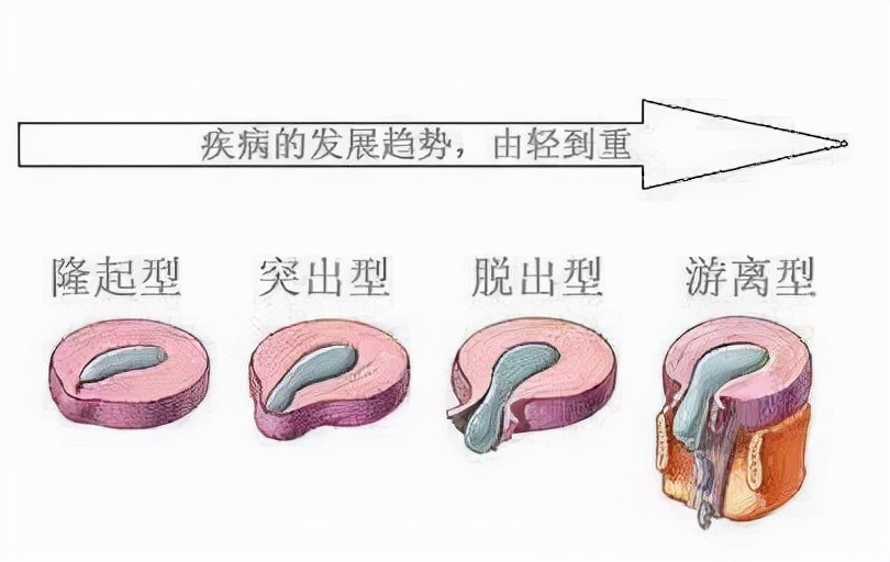 女腰痛要警惕四种原因,男人右边腰痛什么原因
