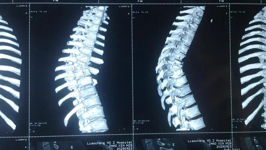 胸椎关节紊乱推拿手法,经方身痛逐瘀散配方