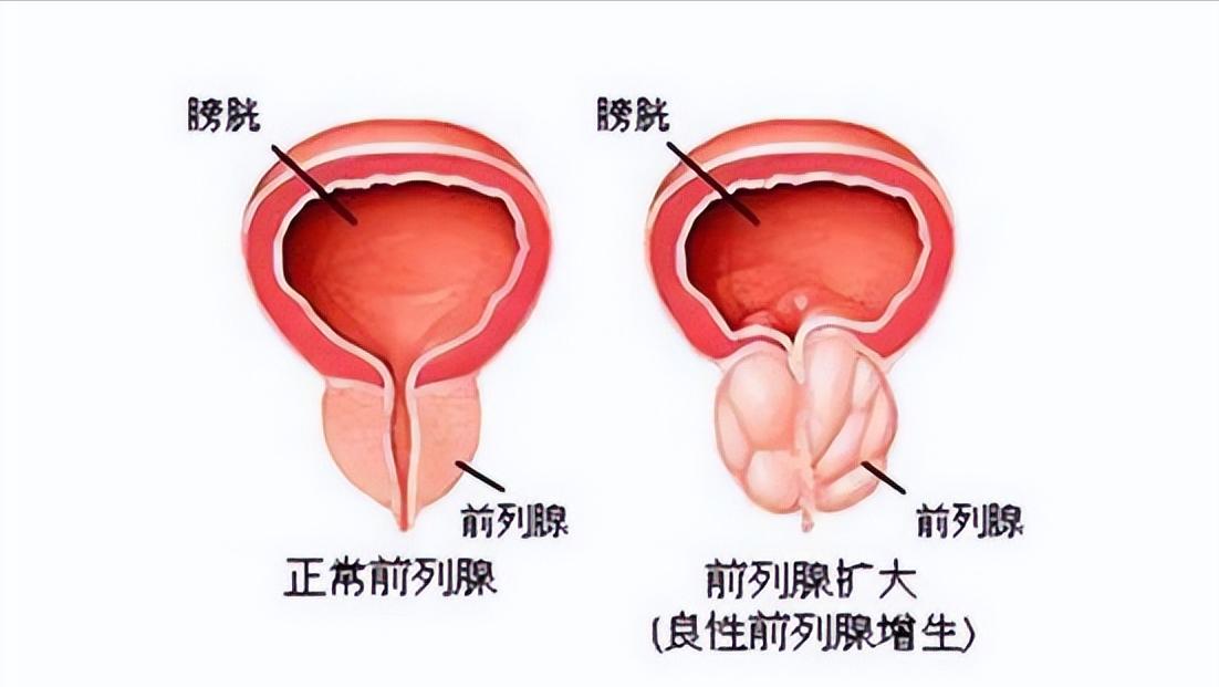 男性前列腺增生肥大如何锻炼,男性的前列腺肥大治愈方法